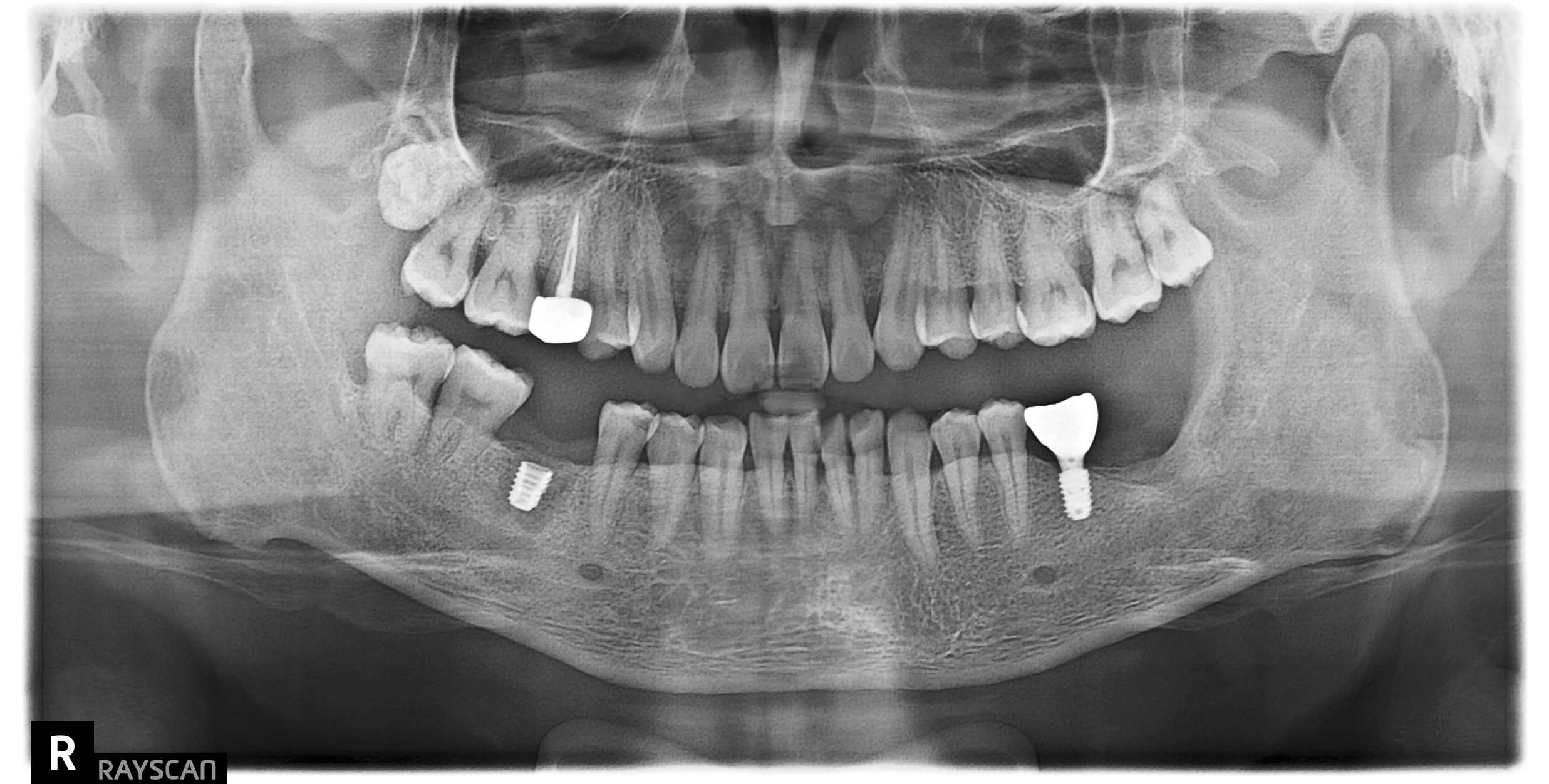 [치료 중] 우측 하악 임플란트 식립