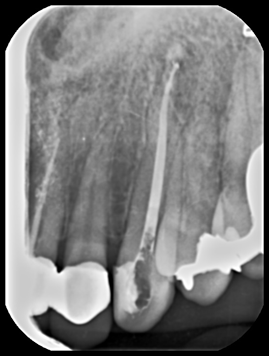 [치료 중] 신경치료 완료 치근단 X-ray