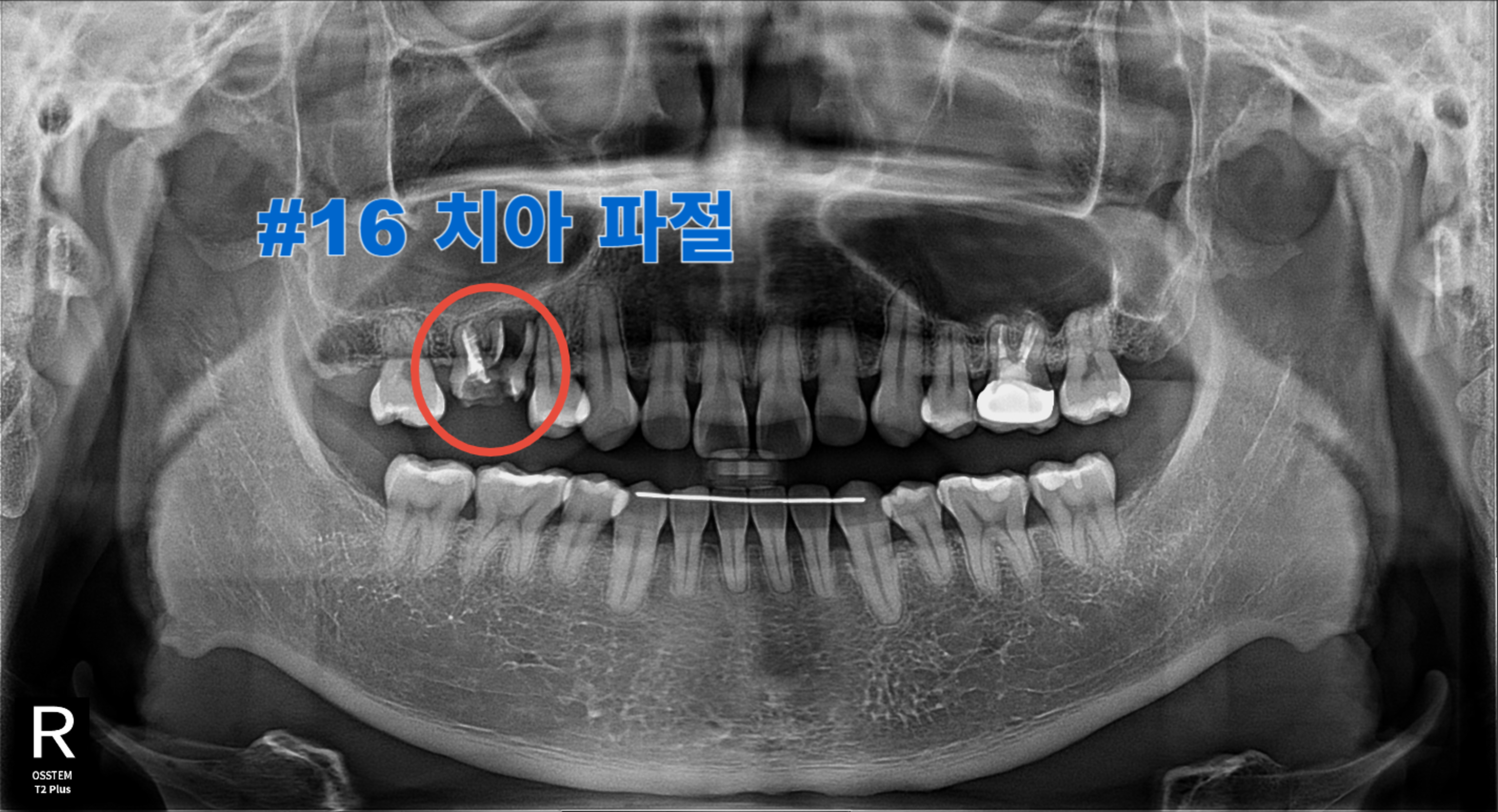 [치료 전] #16 치관 파절로 발치가 필요한 상태