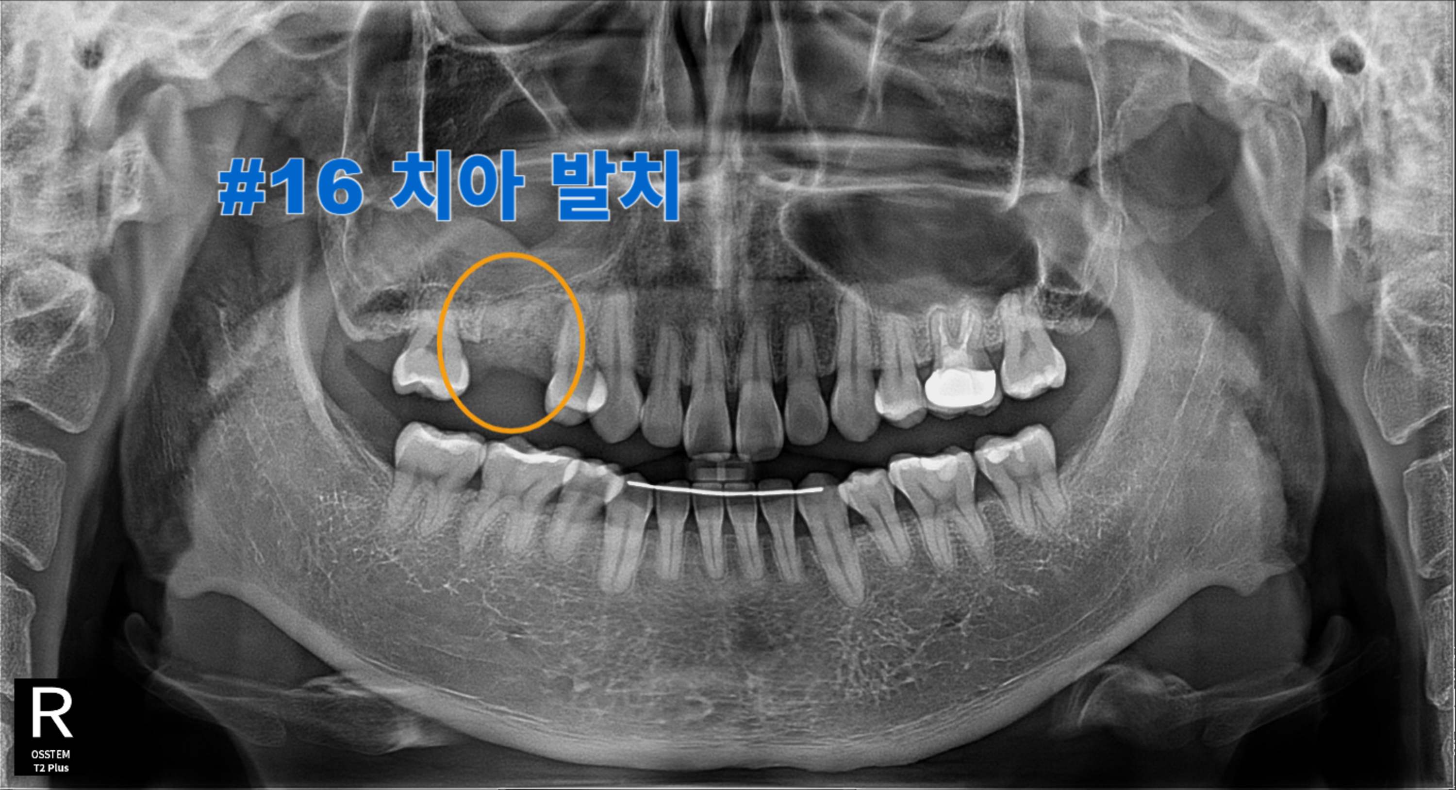 [치료 중] #16 발치 진행
