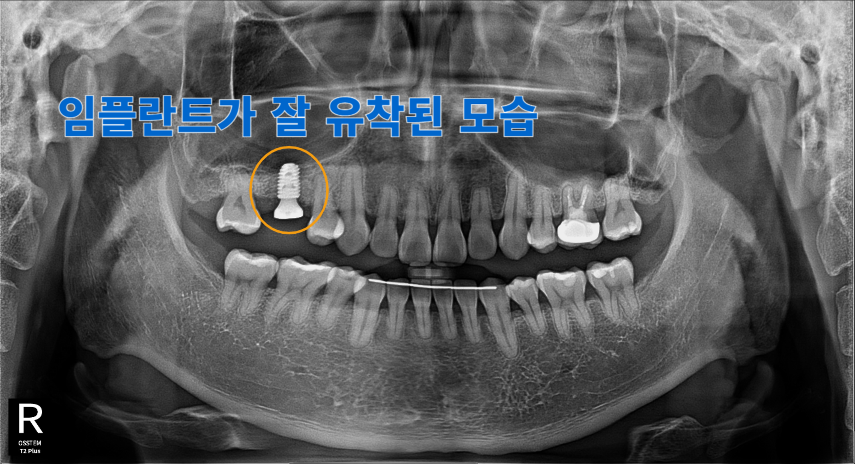 [치료 중] #16 임플란트 식립 후 9개월 경과 후 상태