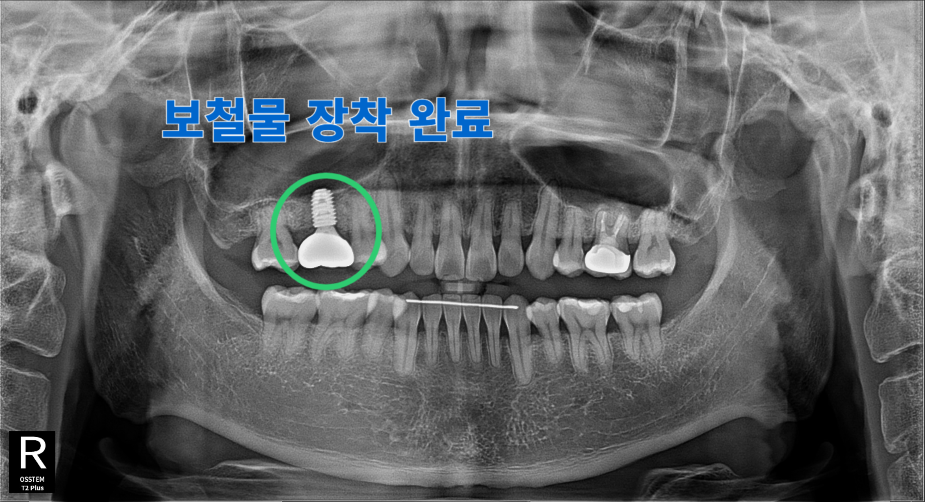 [치료 후] #16 부위 임플란트 보철물 장착 완료