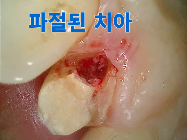 [치료 전] #21 치아 치과파절 설측면 촬영 구내사진