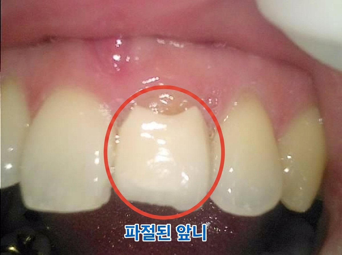[치료 전] #21 치아 순측면에서 촬영한 구내사진으로 치경부 노출
