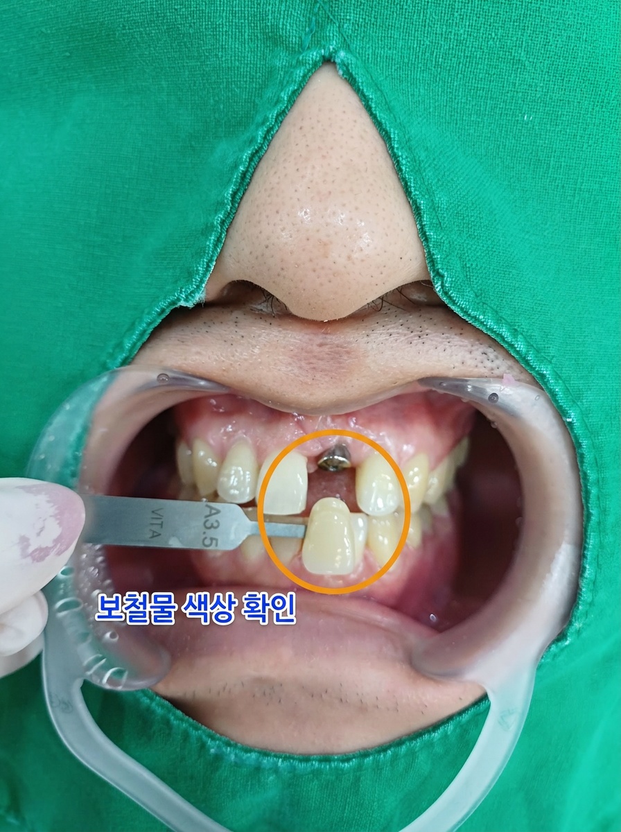 [치료 중] #21 임플란트 식립 후 4개월 경과 후 구내사진 치유상태 양호함