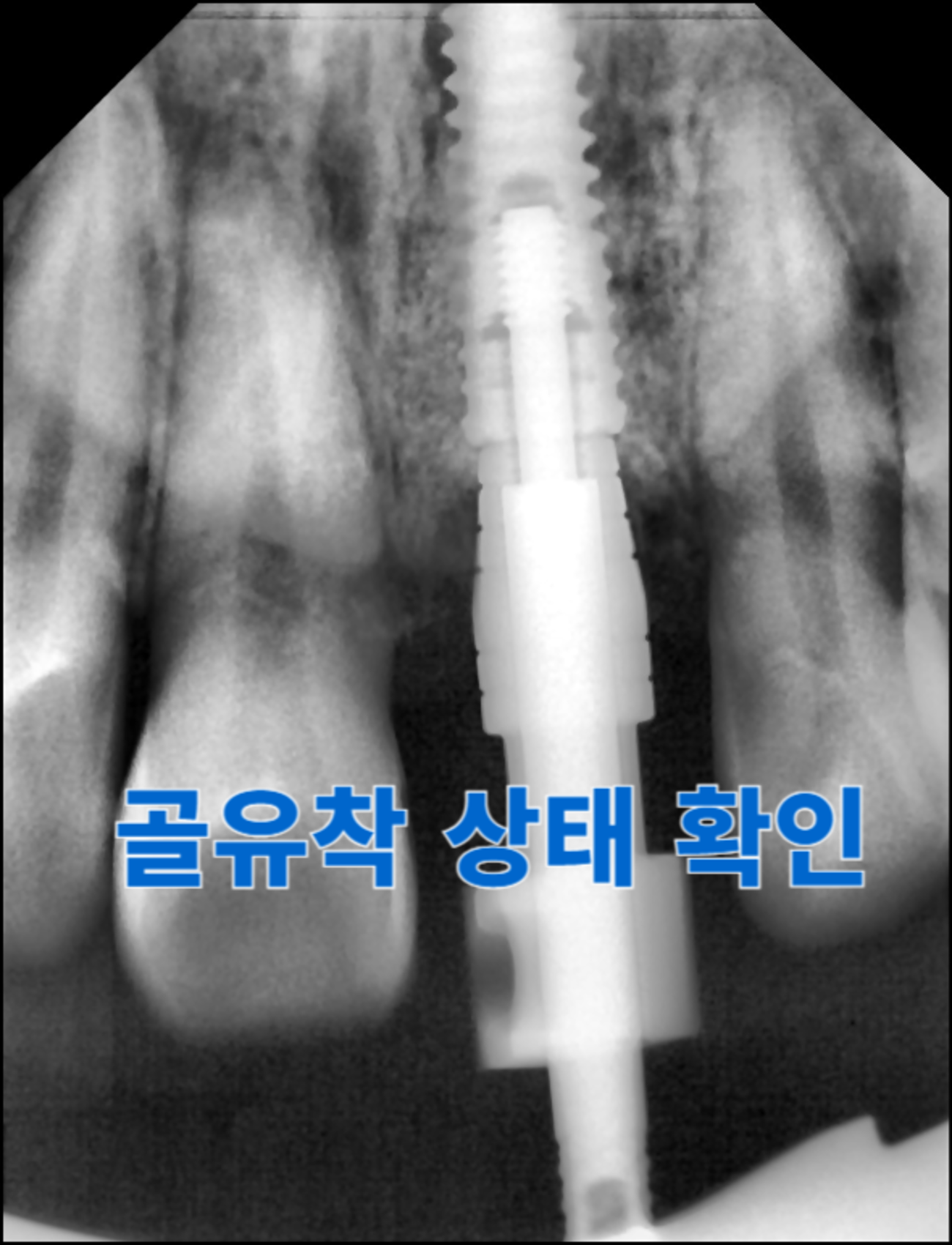 [치료 중] #21 임플란트 식립 후 4개월 경과 후 사진으로 골유착 상태 양호함을 방사선 사진으로 확인