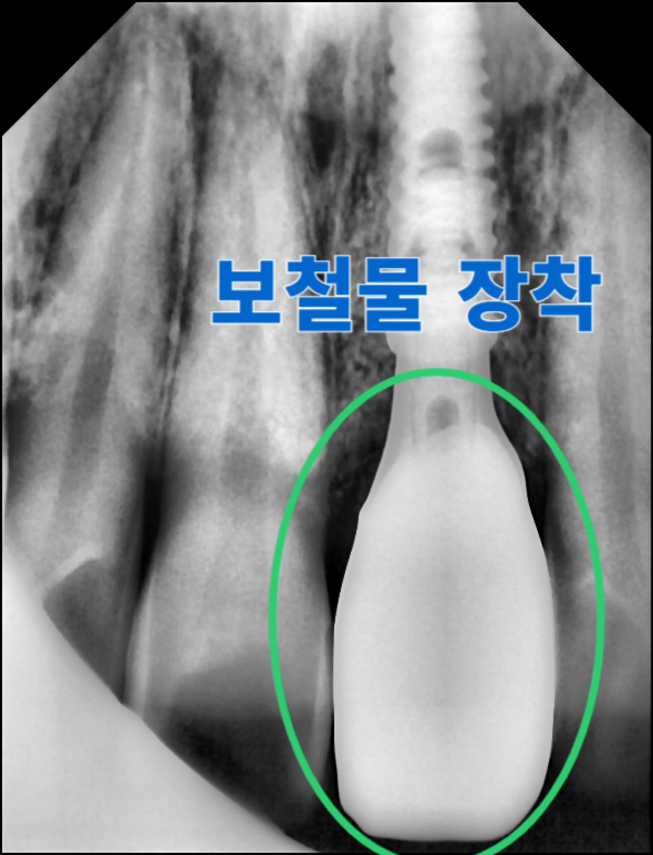 [치료 중] #21 보철물 장착 후 방사선 사진