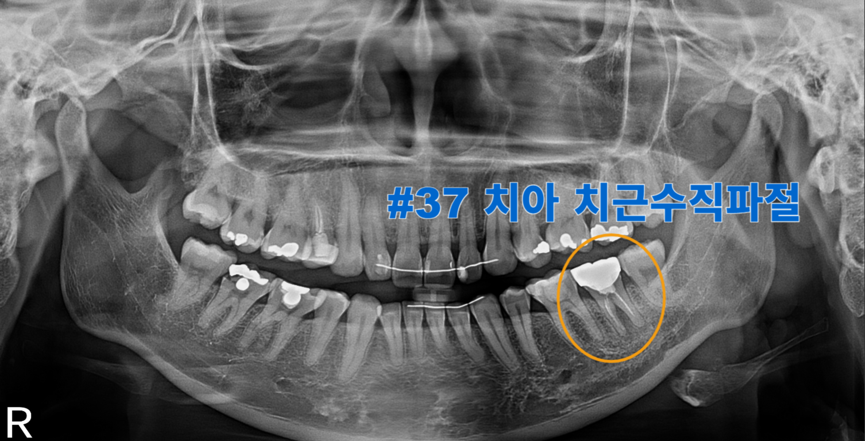 [치료 전] #37 치아에 치근 수직 파절 양상이 관찰되어 CT를 촬영함