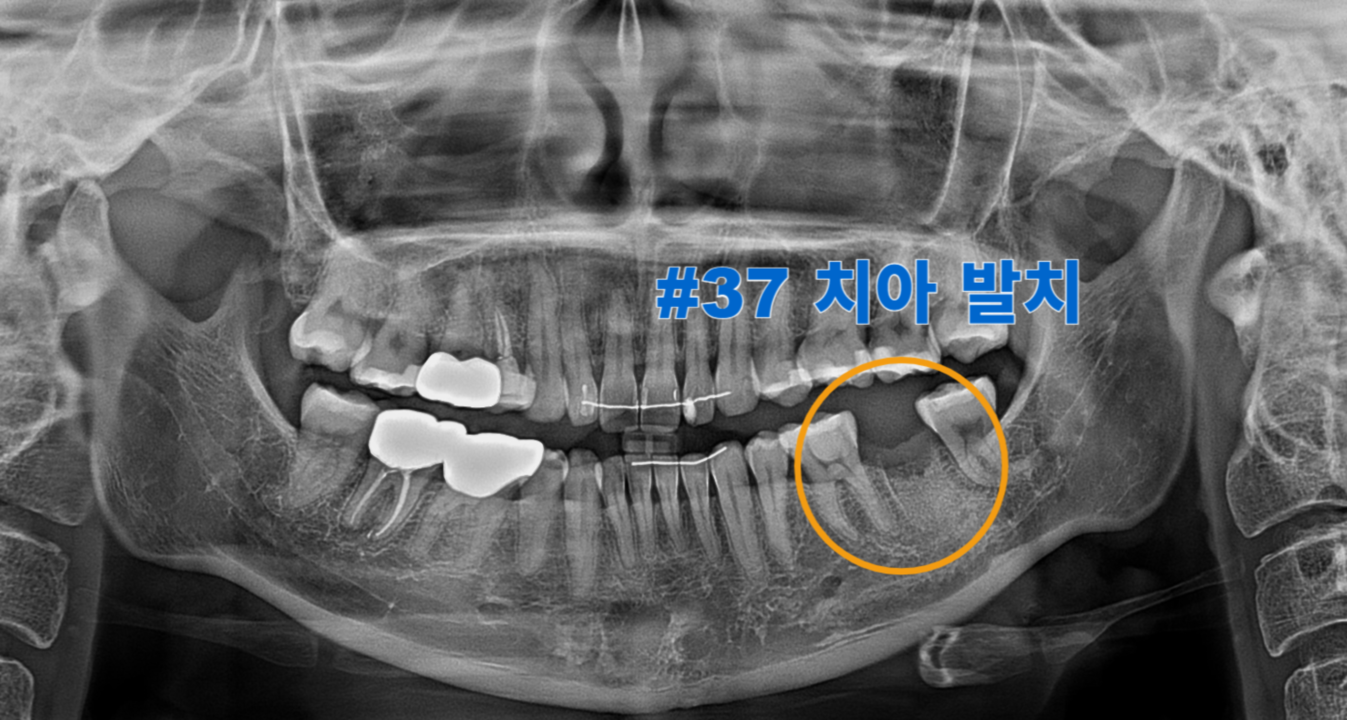 [치료 중] #37 치아 발치