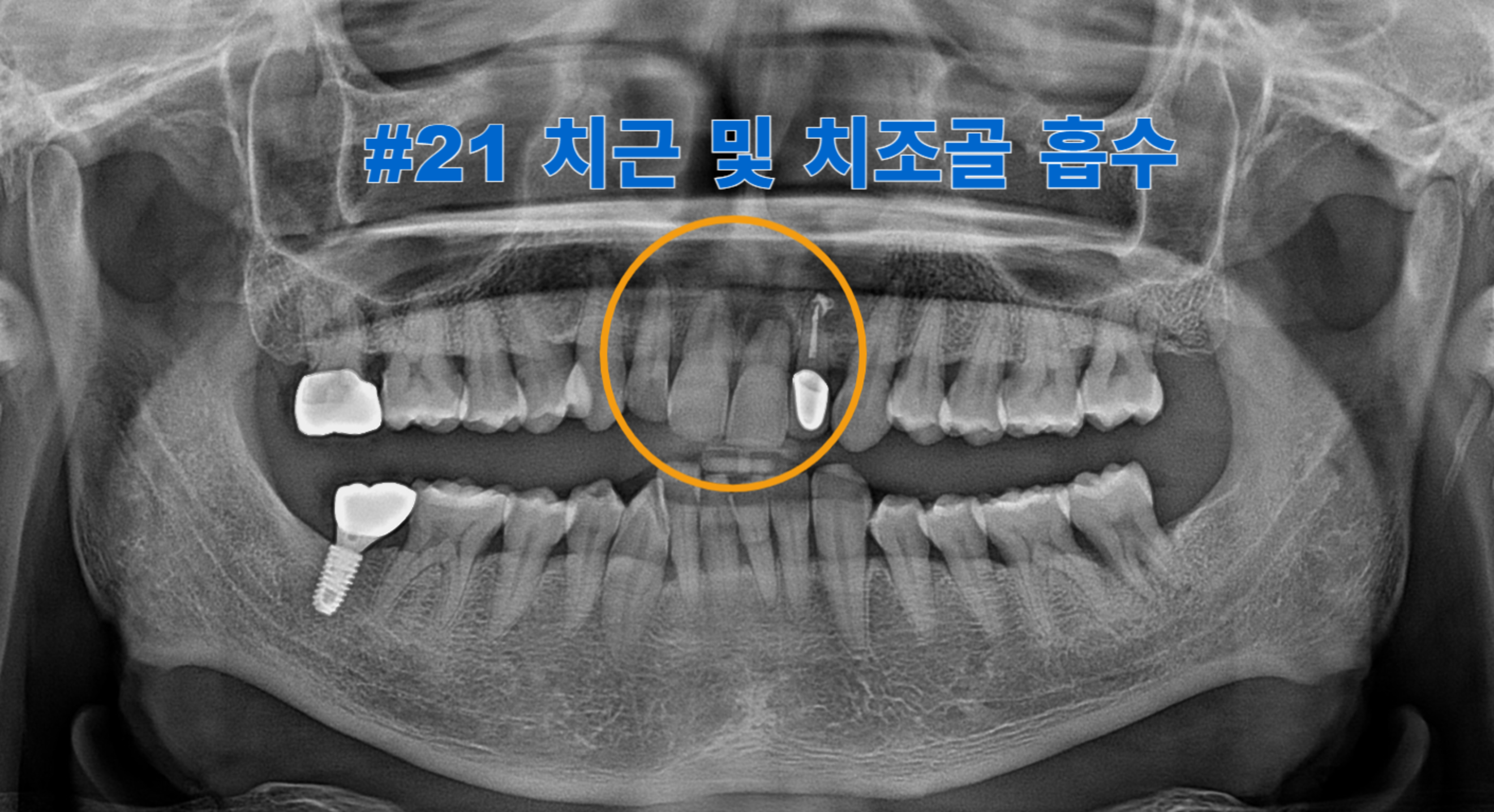 [치료 전] #21 치아 치근 흡수 및 치아 정출 양상 관찰