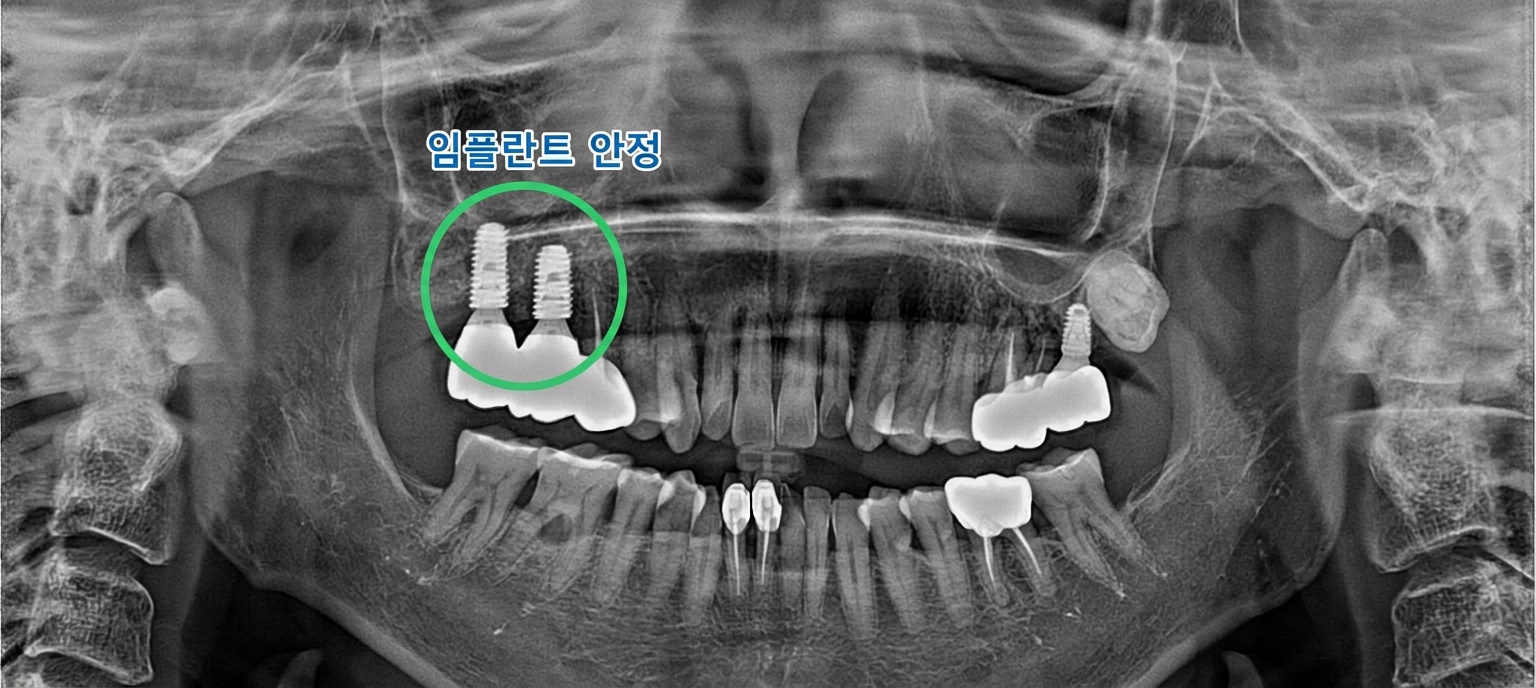 [치료 후] 9개월 후 체크업 사진, #16, 17 임플란트 잘 유지되는 모습 확인