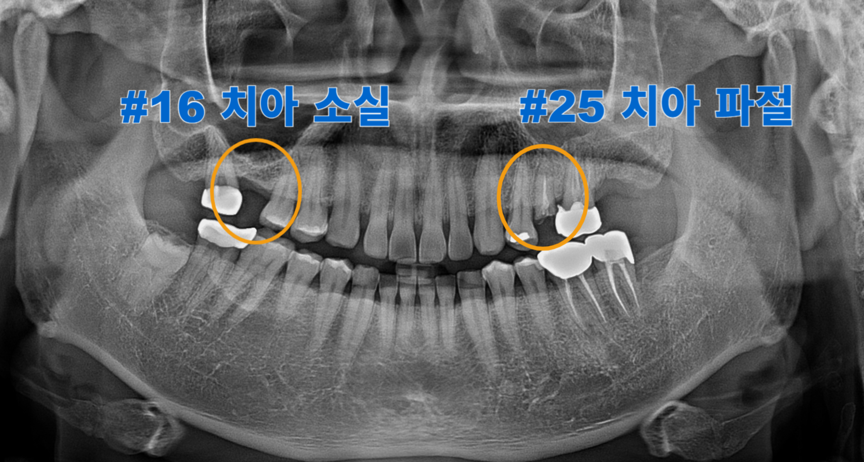 [치료 전] #16 부위 치아 소실, #25 치관파절, #27 부위 치아 소실