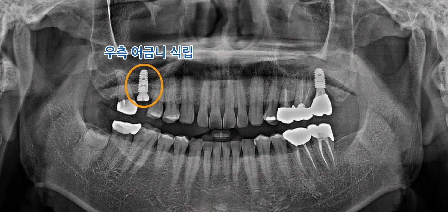 [치료 중] #16 임플란트 픽스처 식립