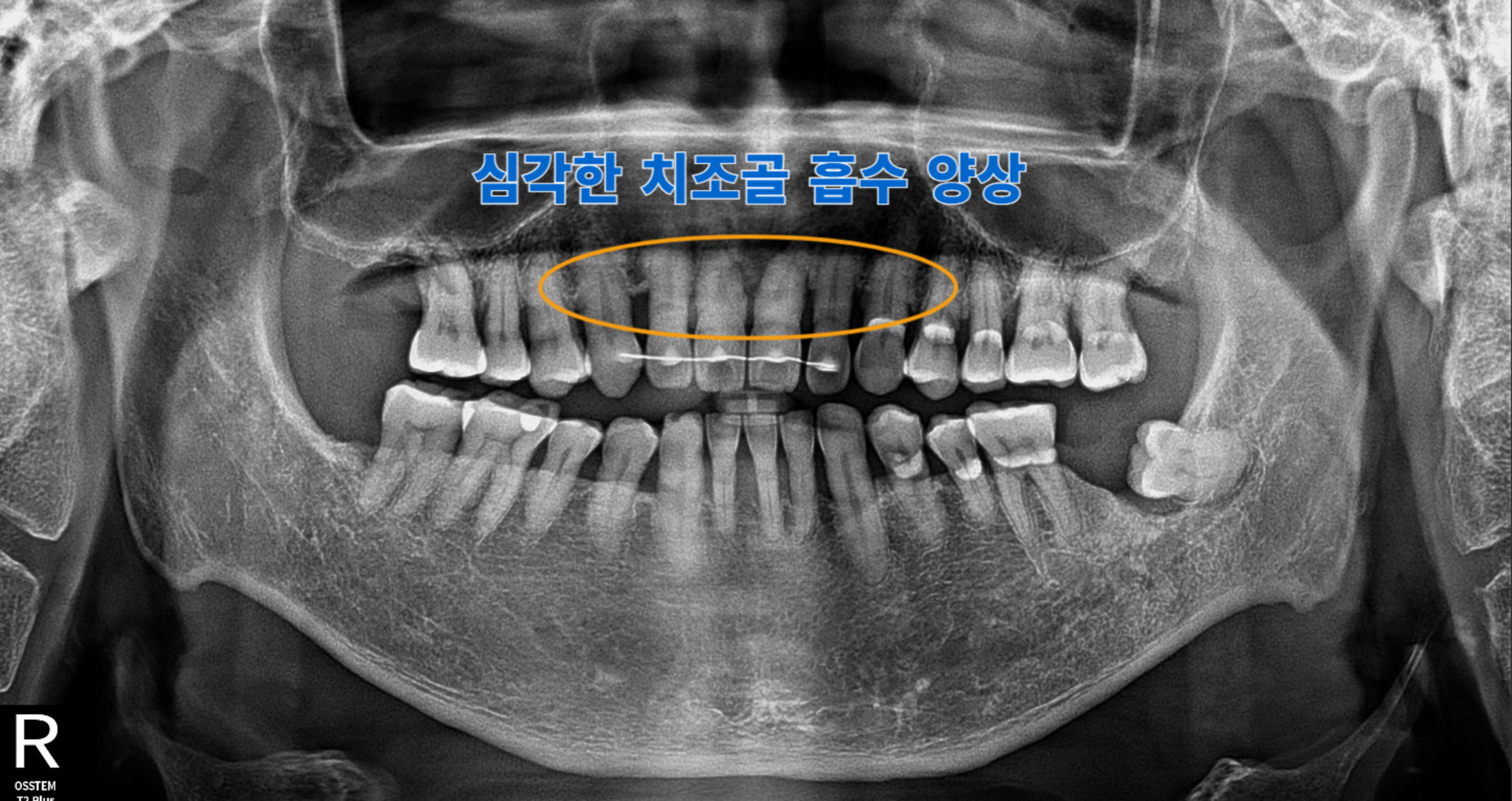 [치료 전] 전치부 과거 외상병력으로 스프린트 부착 상태로 내원, 치조골 흡수 양상 관찰