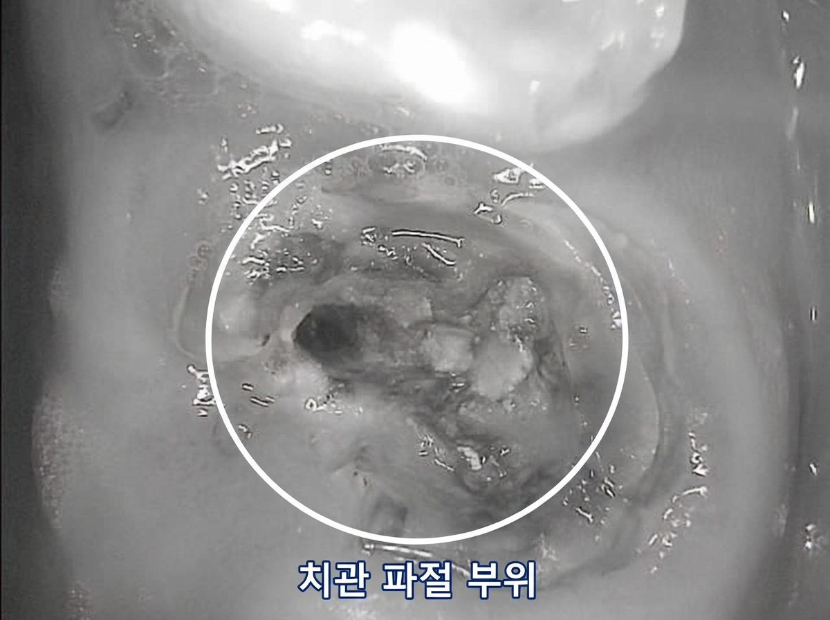 [치료 전] #16 치관 파절 상태