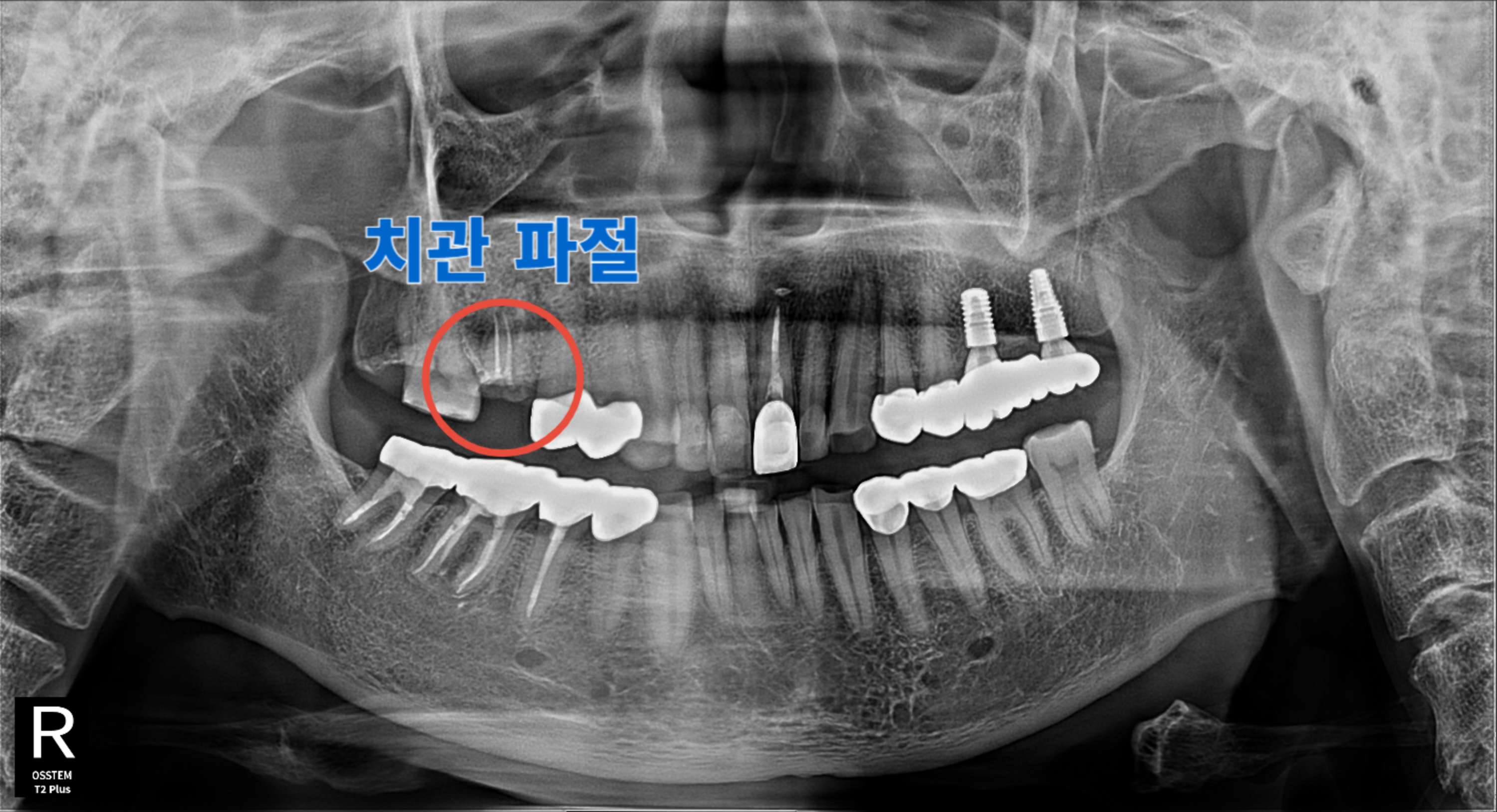 [치료 전] #16 치관 파절 상태 파노라마