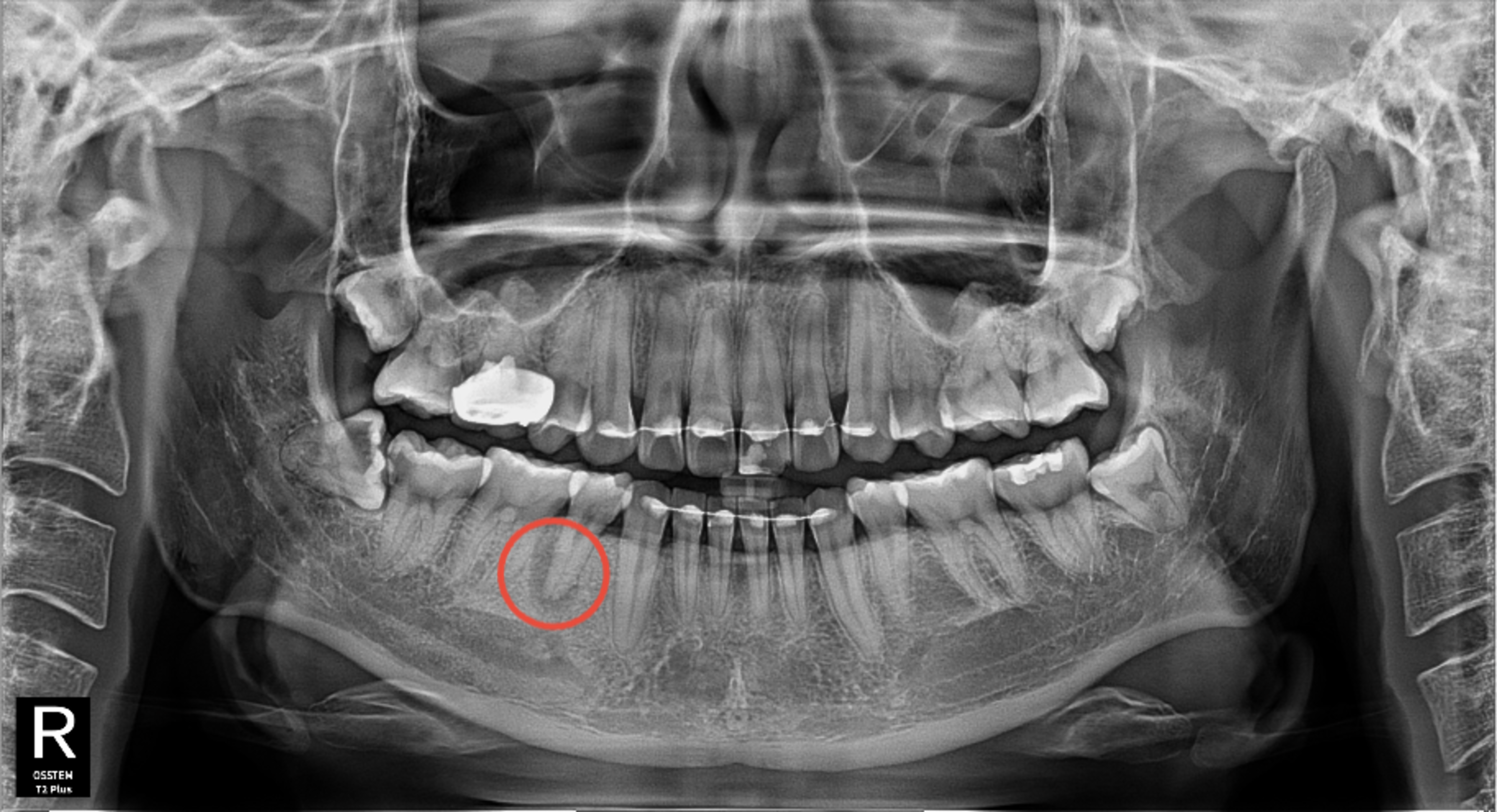 [치료 전] #45 치아 치근단 부위 병소(Periapical lesion)가 관찰됨.