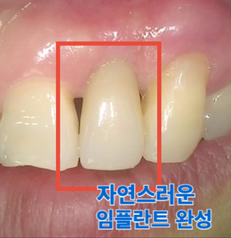 최종 보철물 장착 후 모습
