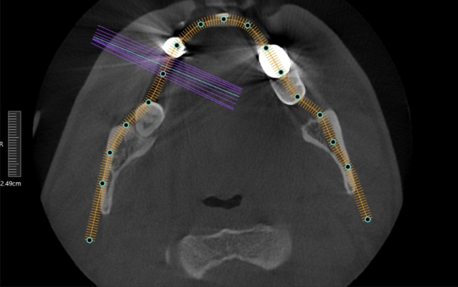 [치료 중] CBCT 영상을 통한 뼈이식 부위의 골유착 및 안정성 확인