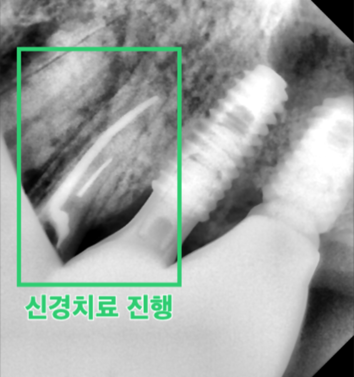 [치료 중] 24 신경치료 진행