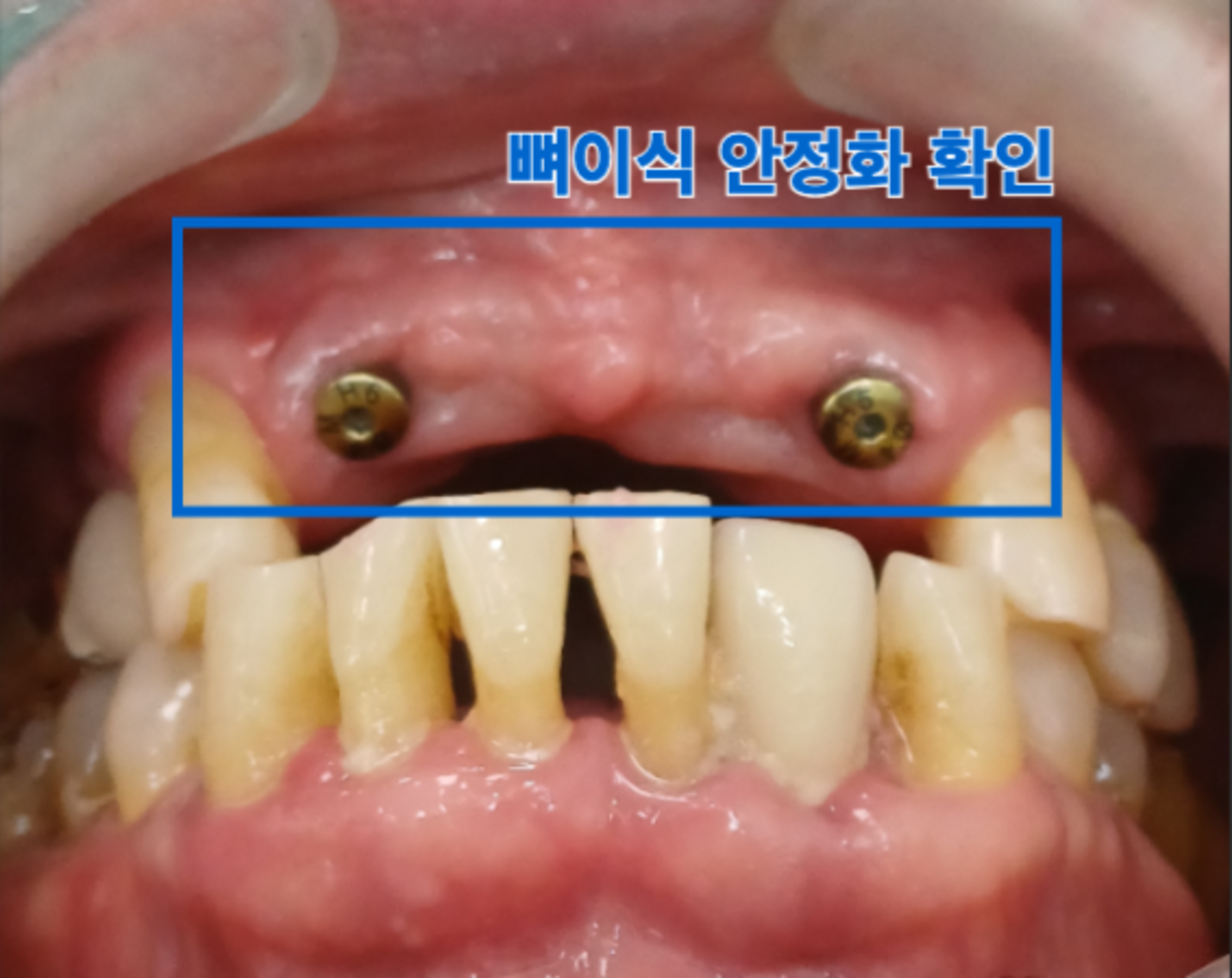 임플란트 식립 후 뼈 유지 상태 확인