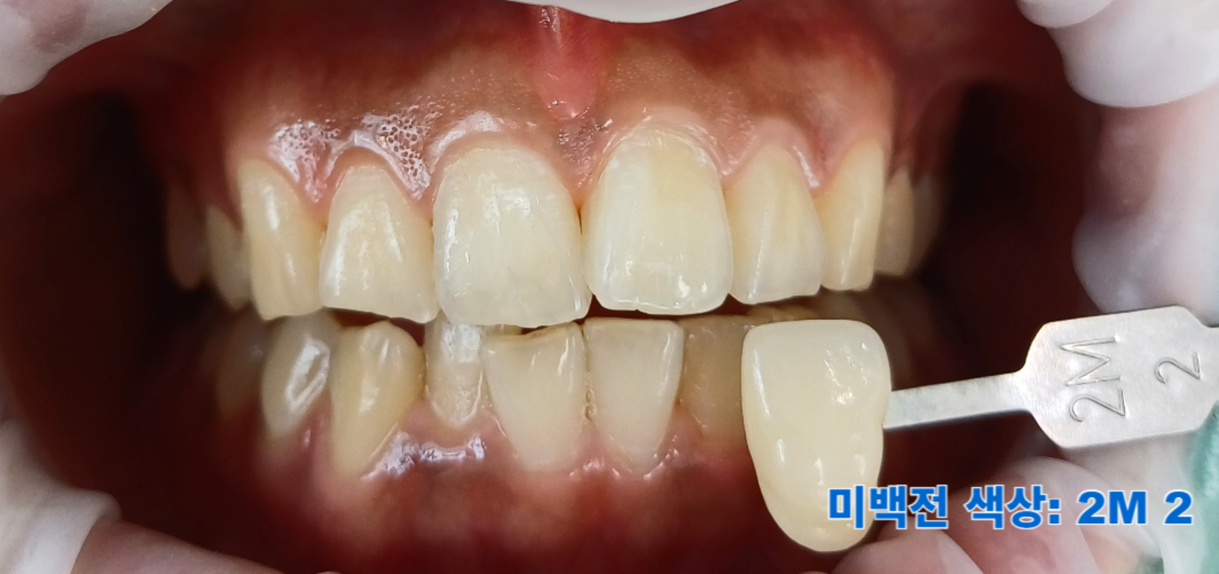 [치료 전] 전문가 치아 미백 전, 쉐이드 가이드상 2M-2, 색상이 어두워서 전문가 미백을 하는 것이 좋다고 판단