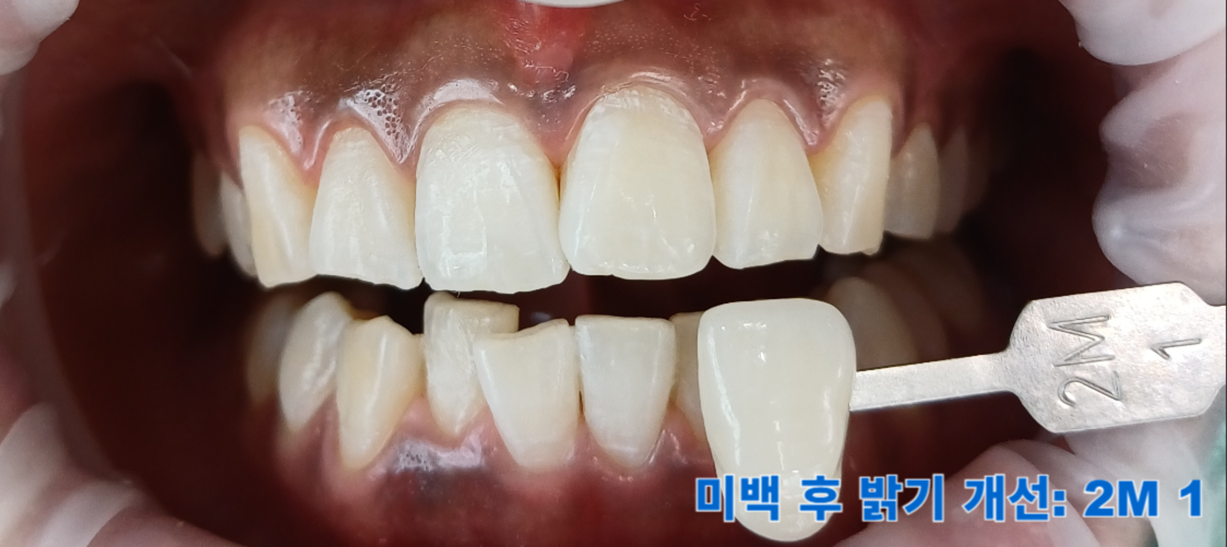 [치료 후] 전문가 미백 후, 쉐이드 가이드 2M-1으로 색상이 밝아짐을 확인할 수 있었음.