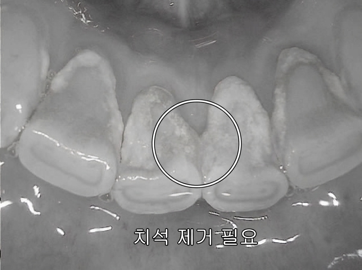 미백 효과 극대화를 위해 하악 전치부 등 치석 제거가 필요한 상태 확인