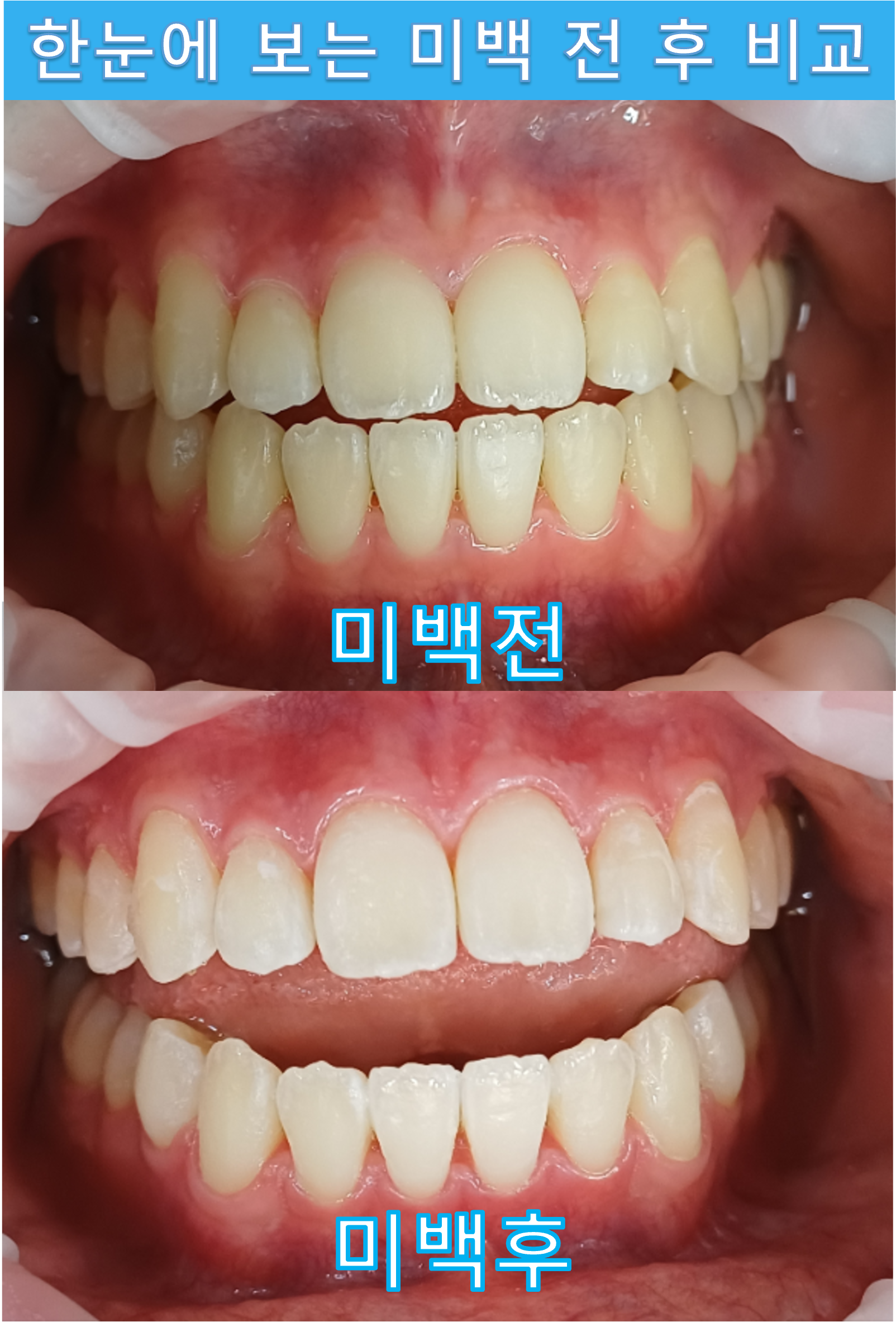 치아 미백 치료 안내 이미지