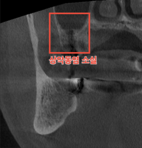 치료 후 깨끗해진 상악동 CT