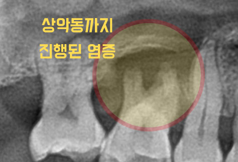 [치료 전] 16 상악동 염증 및 골 소실