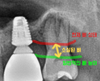[치료 전] 27 치조골 흡수로 인한 치근 노출