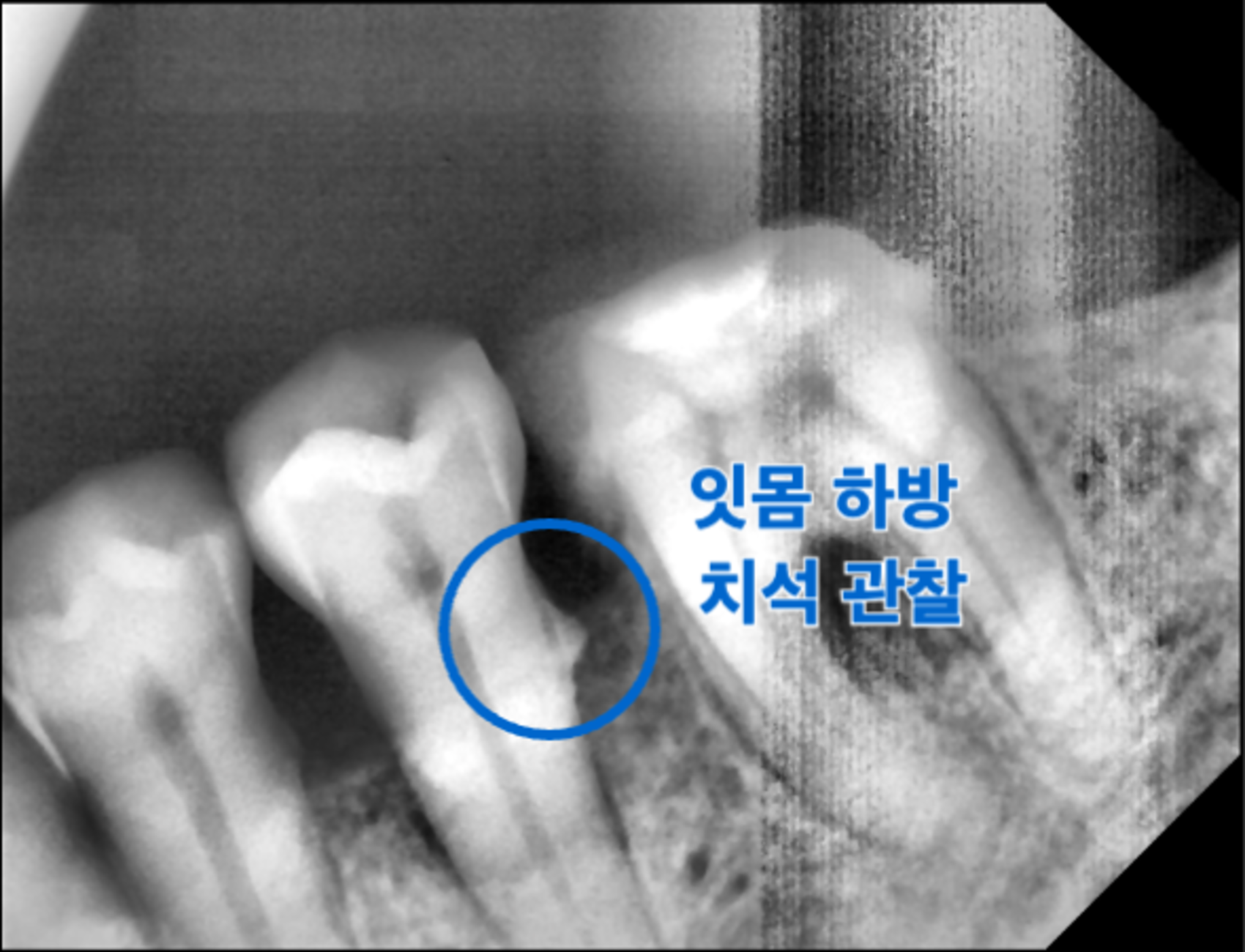 [치료 중] 35 36 사이 치주불량 관찰, 37 임시치아 사용