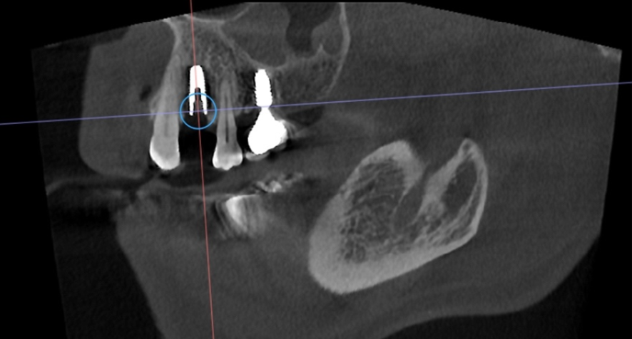 [치료 중] 임플란트 식립 중 CT