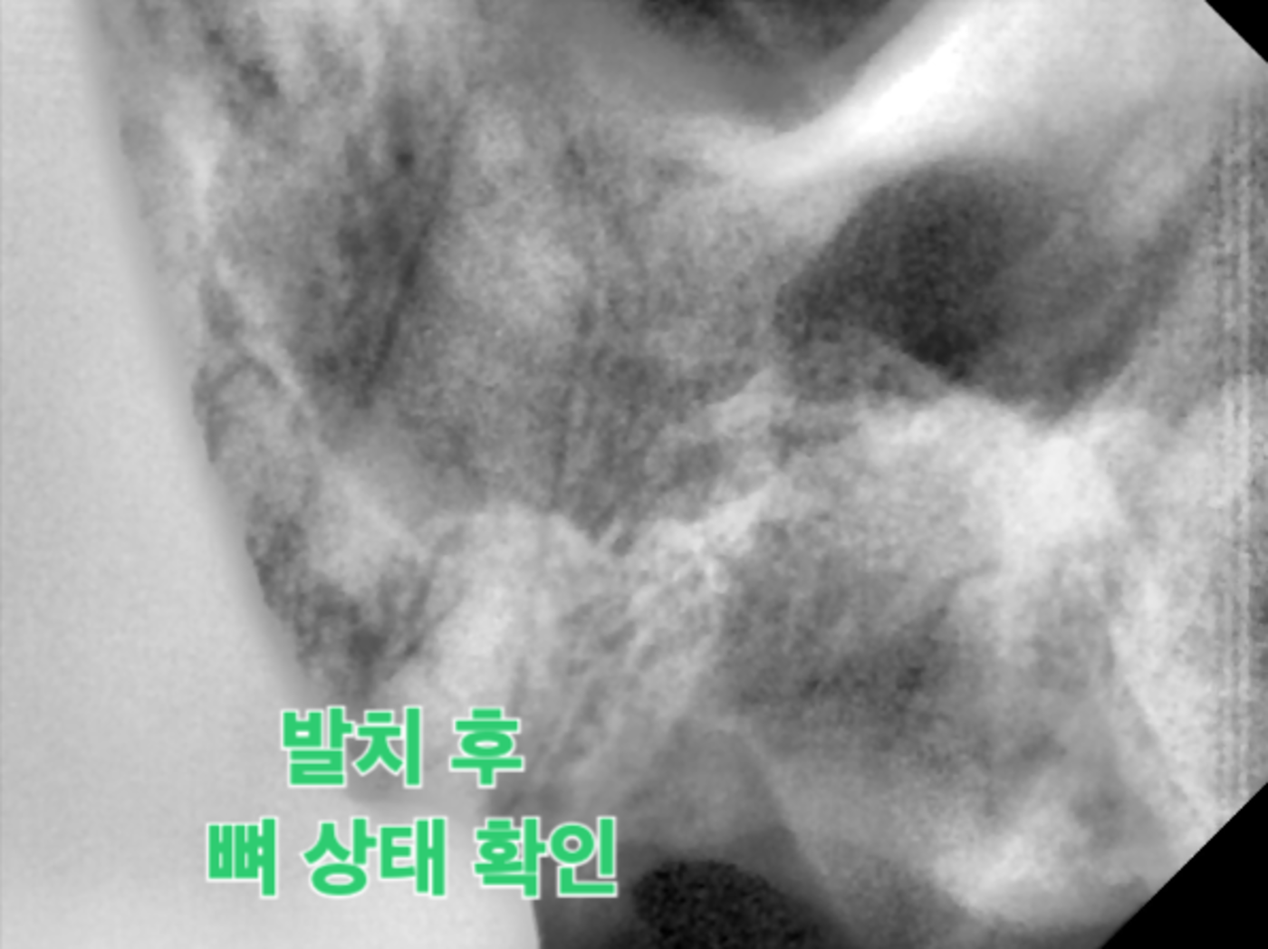 27번 치아 발치 및 내부 염증 제거 PA