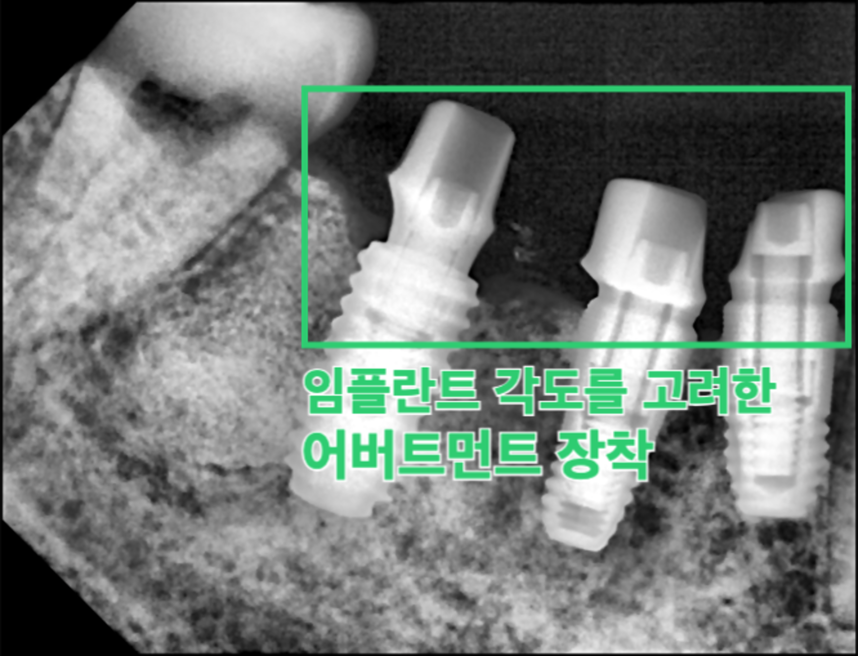 어버트먼트 체결 단계