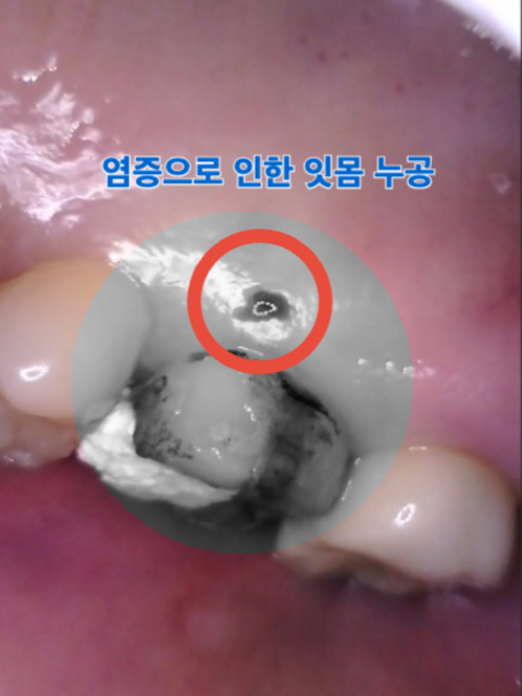 [치료 전] 26번 잇몸 누공 사진