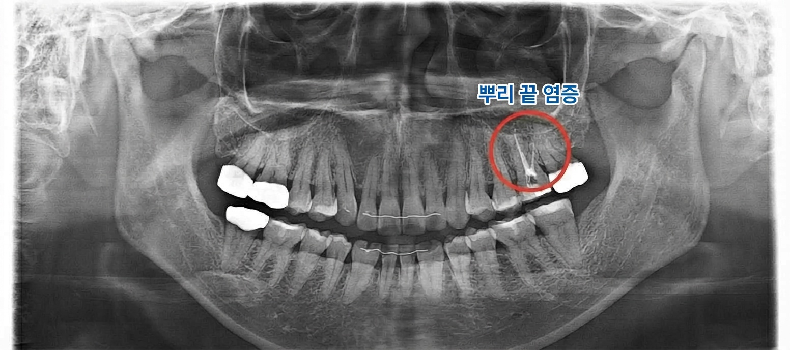 [치료 전] 술전 파노라마 사진