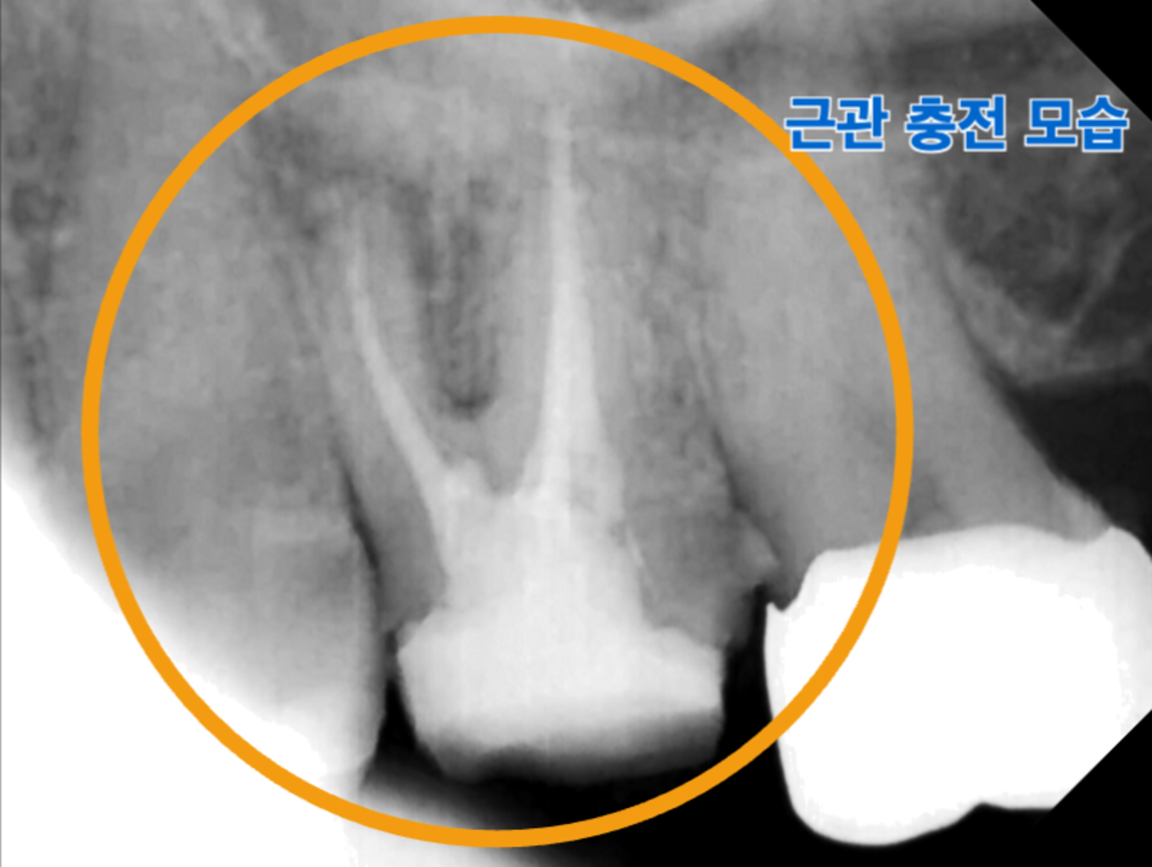 [치료 중] 근관충전 후