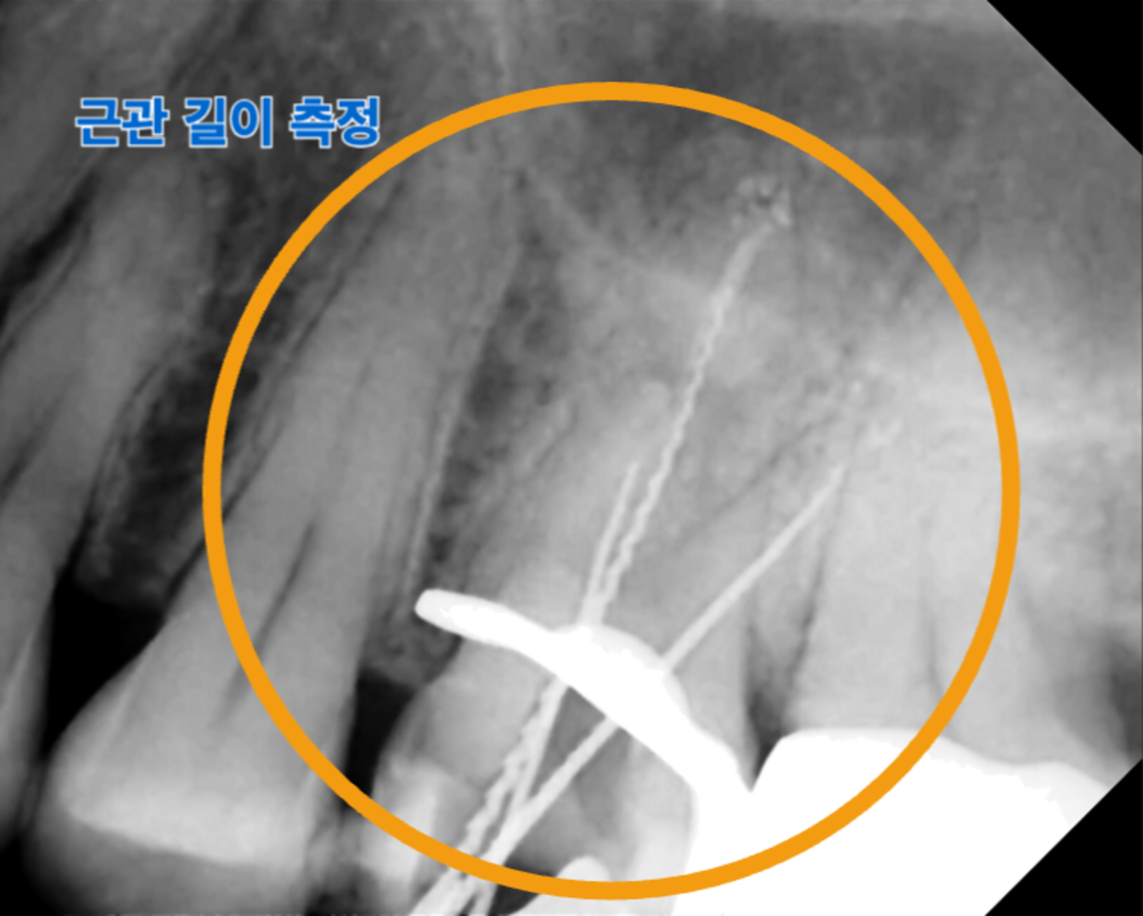 [치료 중] 근관장 측정