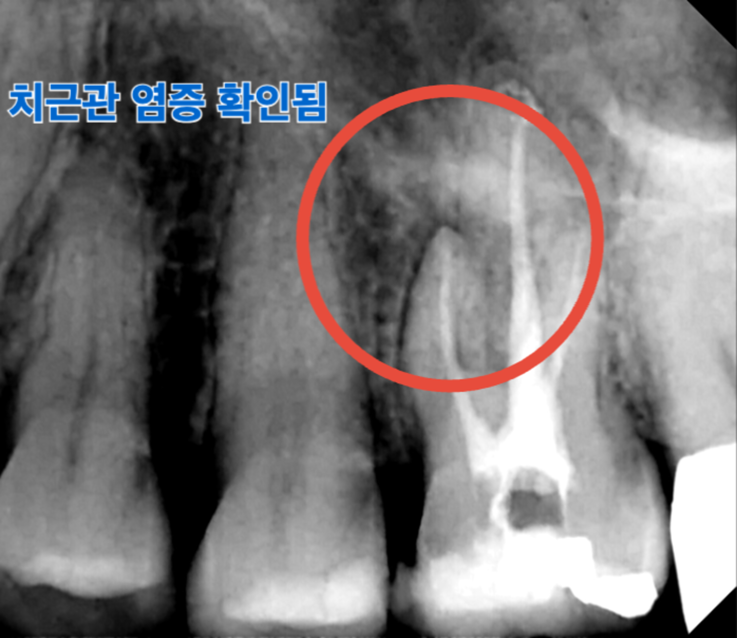 [치료 전] 26번 치근단 염증 사진
