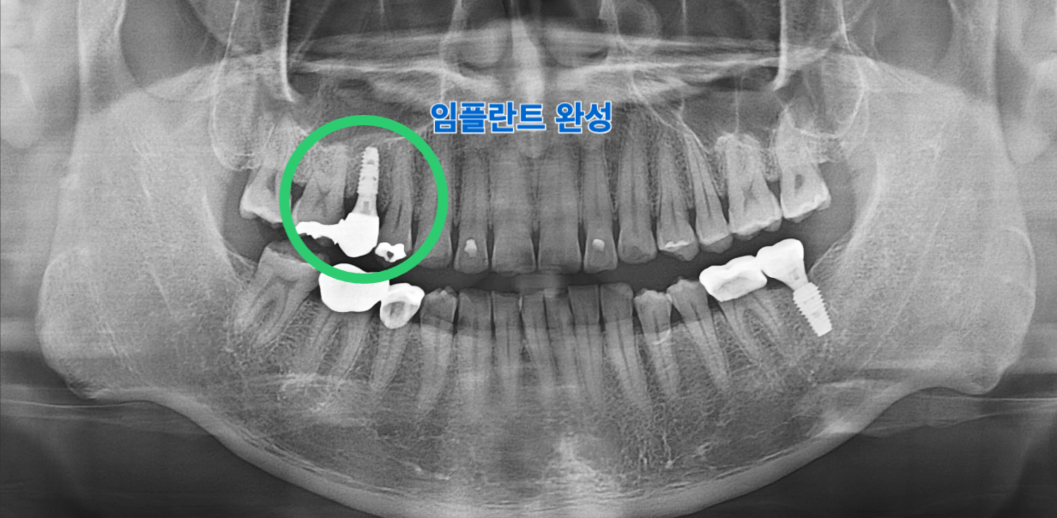 15번 치아 임플란트 보철 완성