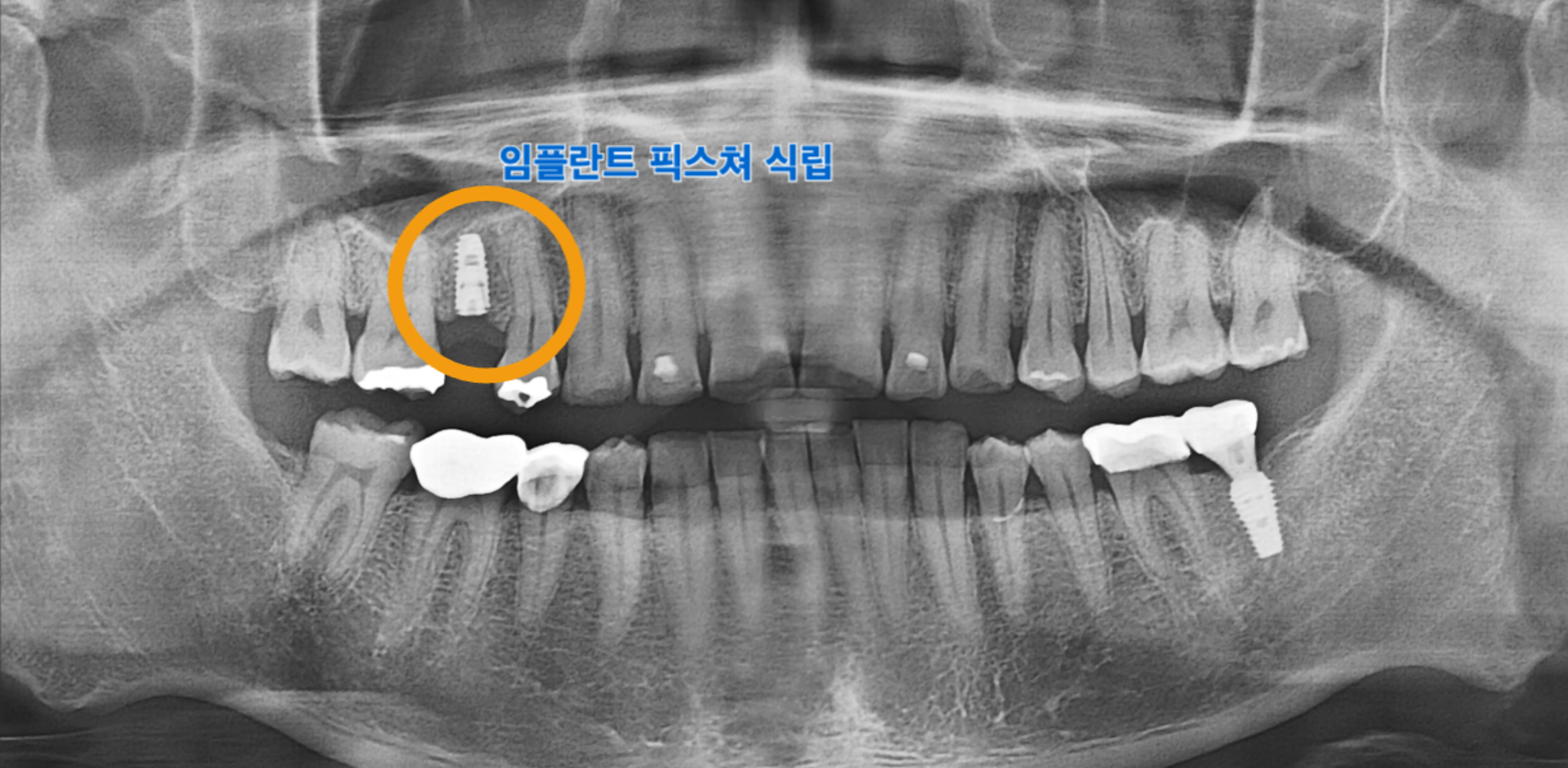 [치료 중] 15번 임플란트 식립