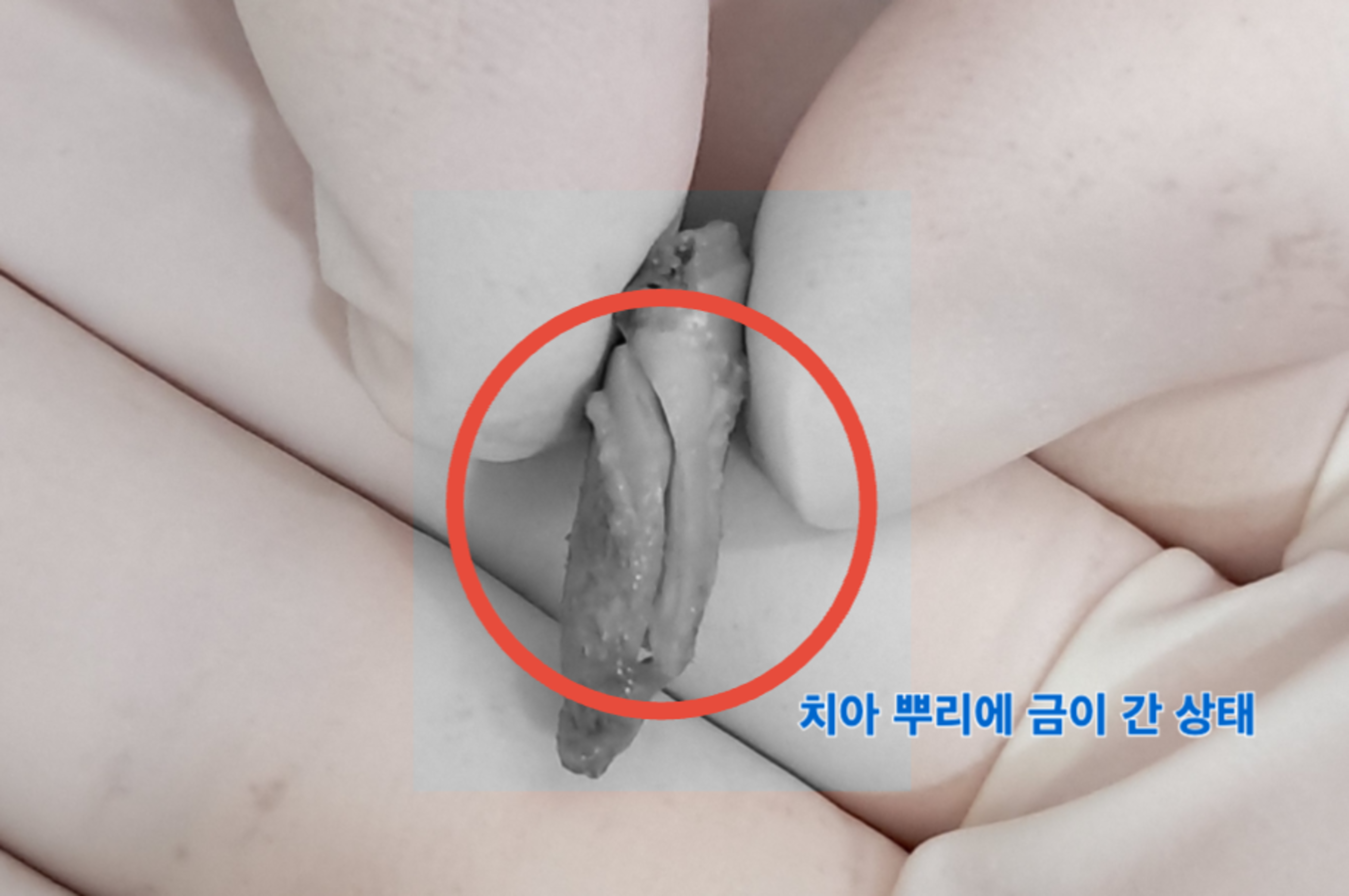 [치료 중] 15번 발치 사진, 수직치근파절 관찰됨