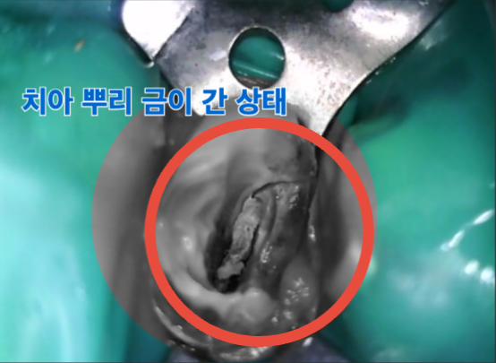 [치료 중] 15번 치근파절 관찰