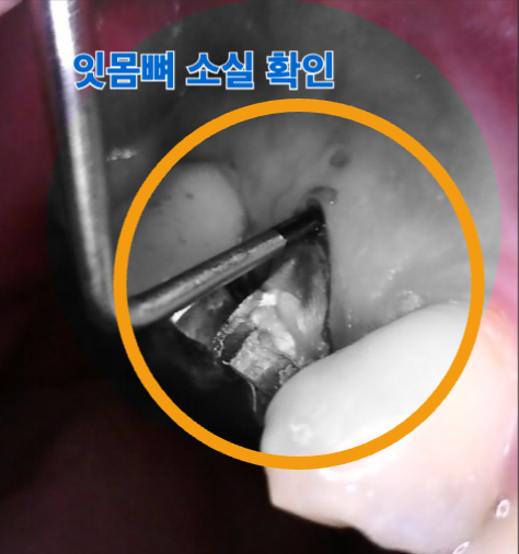 [치료 중] 15번 치주탐침 시 협측 치조골이 수직소실 보여주는 모습