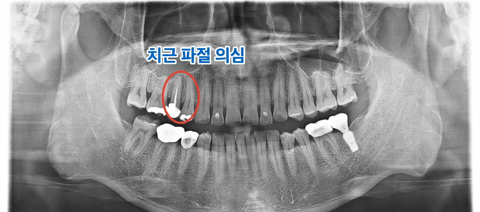 15번 치아 치근단 염증 상태