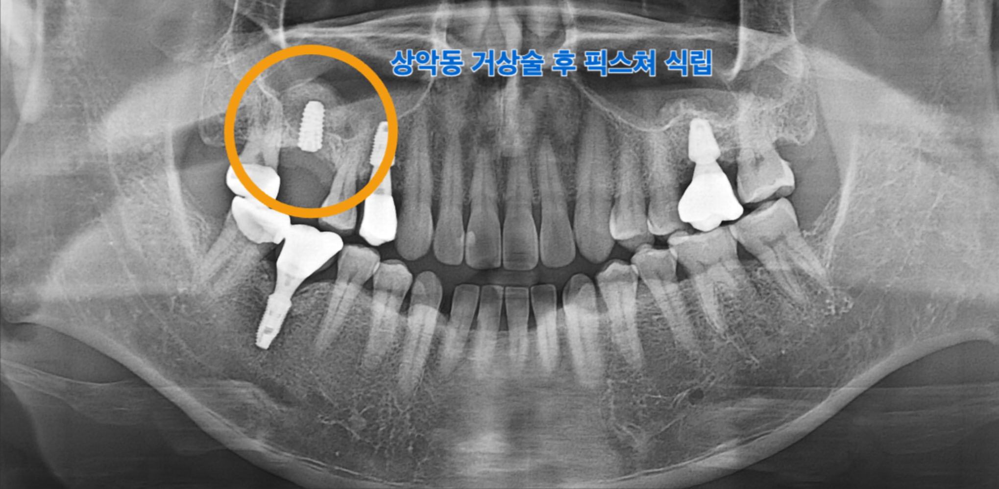 Lateral approach방식 상악동거상술