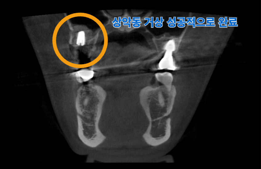 상악동 거상술 수술 직 후 CT