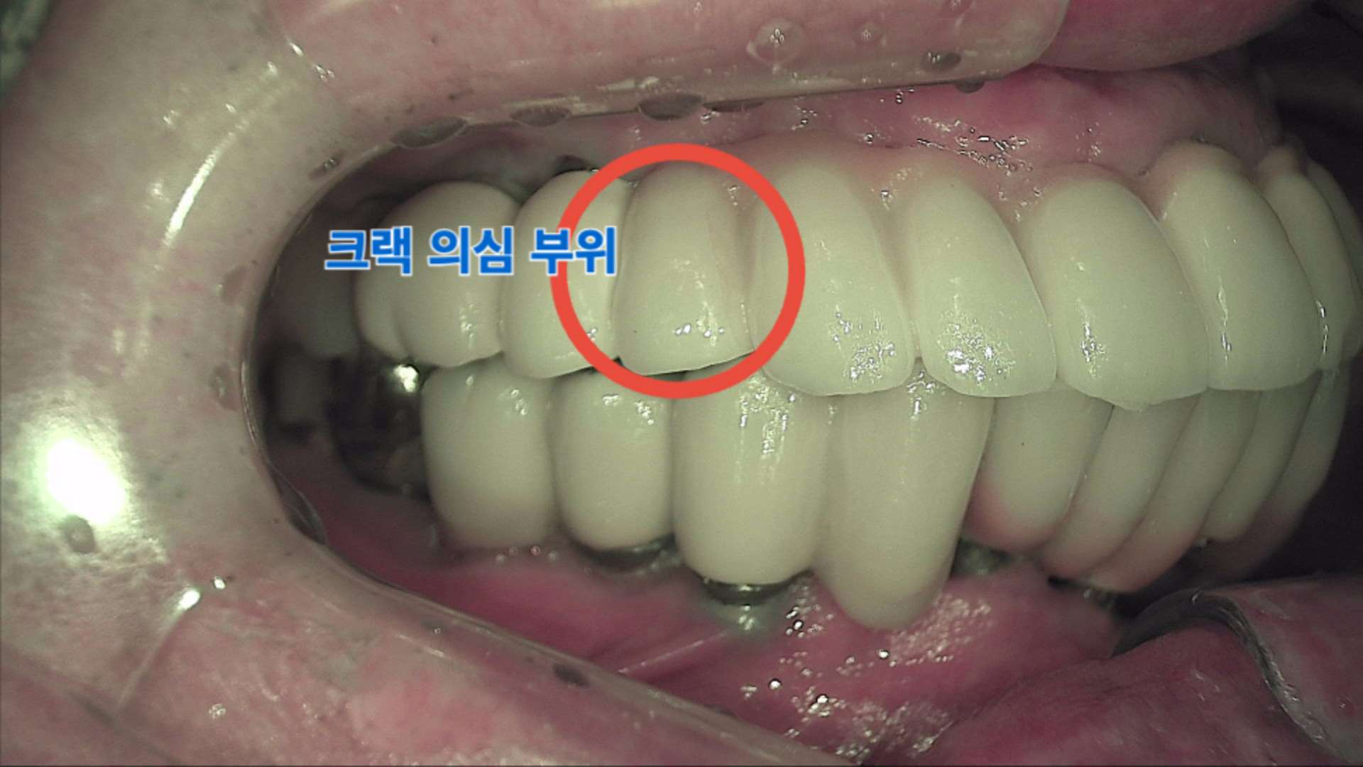 육안으로 관찰된 임플란트 보철물 미세 균열 의심 소견